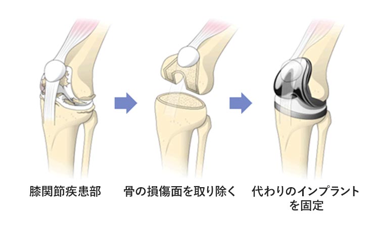 人工膝関節置換術のイメージイラスト