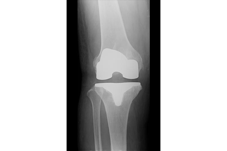 人工膝関節置換術の術前術後